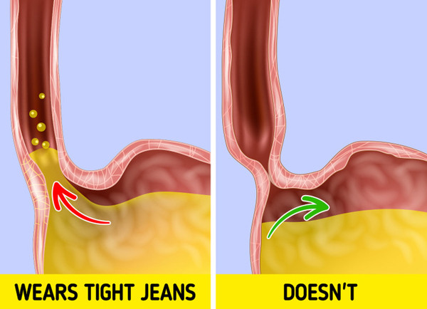 Tăng nguy cơ ợ nóng. Chú ý quan sát, bạn sẽ nhận thấy mặc quần jeans thời gian dài sẽ để lại đường hằn sâu, tấy đỏ quanh eo. Chuyên gia cho biết, quần áo bó sát tạo áp lực quanh vùng bụng có thể gây trào ngược axit.