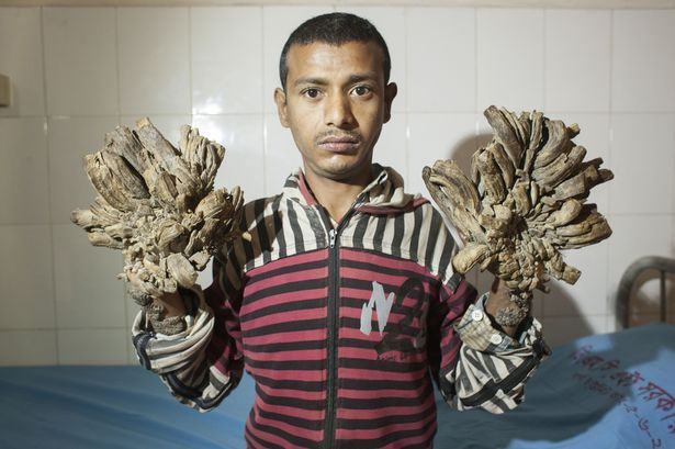 Chàng trai Abul Bazadar, 25 tuổi, người Bangladesh, bị nhiễm một loại hội chứng người cây có tên khoa học là “Human Pappiloma Virus” (HPV) khi 10 tuổi. Kể từ đó, chàng trai này được mệnh danh là người cây hay người có bàn tay hoa.