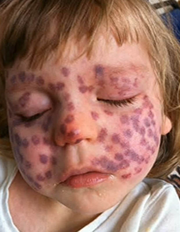 Khi vừa sinh ra, Matilda đã có những vết chàm trên mặt. Lúc đầu, các bác sỹ nghĩ rằng đó chỉ là những vết bầm tím. Tuy nhiên, khoảng 2 tuần sau đó, Matilda được chẩn đoán mắc hội chứng Sturge Weber, đây là một dạng rối loạn thần kinh da hiếm gặp.
