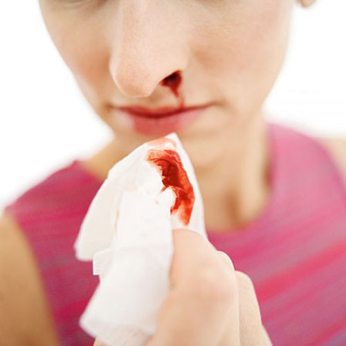 Chảy nước mũi một bên và có kèm theo máu cũng là một trong những dấu hiệu để chẩn đoán nguy cơ ung thư vòm họng. (Nguồn Songkhoe)