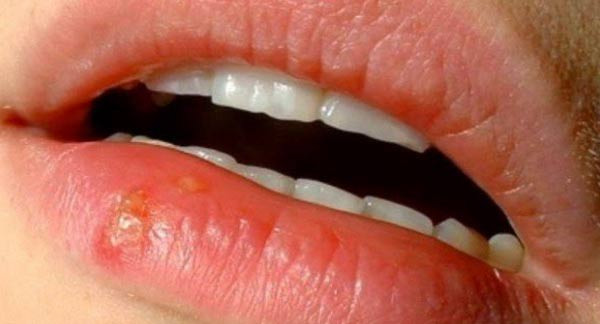 Lá tre trị chứng miệng lưỡi lở loét. Liều lượng: 20g búp tre, 10g sinh địa, 10g mộc thông, 8g cam thảo. Cách dùng: sắc uống thay nước trong ngày.