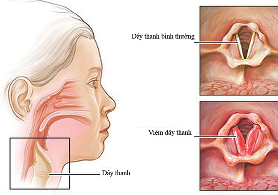 Lá tre chữa cảm sốt, miệng khô khát. Liều lượng: 30g lá tre, 12g thạch cao, 8g mạch môn, 7g gạo tẻ, 4g bán hạ, 2g nhân sâm, 2g cam thảo. Cách dùng: sắc uống, 1 thang thuốc/ ngày.
