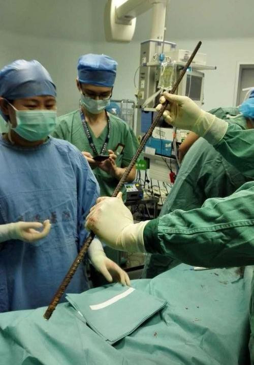 Thanh sắt dài 1,5 mét được các bác sĩ lấy ra từ người bệnh nhân.