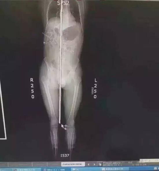 Các bác sĩ cho biết, tình trạng bệnh nhân đã ổn định hơn và được chuyển đến đơn vị chăm sóc đặc biệt để theo dõi 2 tuần phòng các nguy cơ nhiễm trùng.