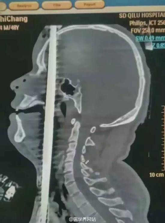 Kết quả chụp X-quang cho thấy, bệnh nhân này bị thanh sắt dài 1,5 mét đâm xuyên hộp sọ, qua khí quản, tim, động mạch và gan.