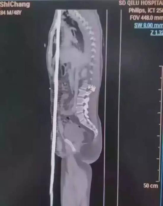 Ngay sau đó, người đàn ông này đã được đưa vào phòng phẫu thuật khẩn cấp. Sau ca phẫu thuật kéo dài 7 giờ, thanh sắt đã được loại bỏ ra khỏi cơ thể bệnh nhân.