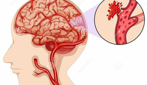 Người mắc bệnh mạch máu não không nên tắm thường xuyên. Lý giải không nên tắm trường hợp này, bác sĩ cho biết kích thích nhiệt sinh ra trong quá trình tắm sẽ làm tăng tốc độ lưu thông máu trong cơ thể, làm tăng áp lực máu lên các mạch máu. Điều này khiến máu lưu thông qua các vùng tổn thương có thể gây ra hiện tượng vỡ mạch.