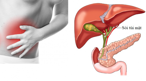 Tổn thương túi mật. Bỏ bữa tối kéo dài còn làm tăng lượng cholesterol, tổn thương túi mật. Thậm chí, trường hợp nặng có thể gây kết sỏi tiết niệu.