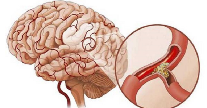 Cao huyết áp là nguyên nhân gây tai biến mạch máu não hàng đầu. Người bị cao huyết áp có nguy cơ tai biến cao gấp 3 – 4 lần so với người có chỉ số huyết áp bình thường. Ảnh: amazonaws.