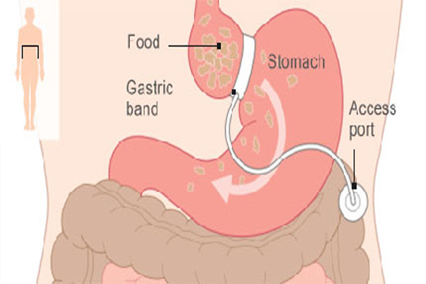 Phẫu thuật Bariatric giảm cân chữa bệnh tiểu đường. Béo phì tỷ lệ thuận với bệnh tiểu đường loại 2. Hiện nay, nhiều người Mỹ đang lựa chọn loại hình phẫu thuật nài để thu hẹp dạ dày hoặc cắt bỏ những phần dạ dày không cần thiết. Phải mất 1 năm hậu phẫu thì cân nặng mới xuống nhưng mức độ đường trong máu lại giảm đi rất nhanh.