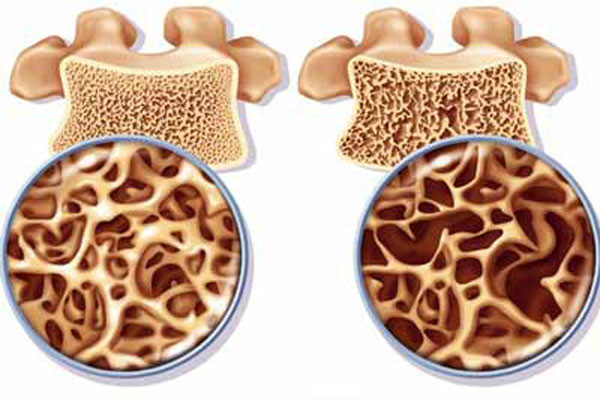 9. Loãng xương. Lượng vitamin D đầy đủ rất quan trọng cho việc duy trì mật độ xương. Thiếu vitamin D sẽ khiến cho lượng canxi cạn kiệt, cho xương bị suy yếu và tăng nguy cơ gãy xương.