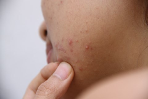 Có thể nói lớp lông mặt trên da như một lớp bảo vệ da của bạn tránh khỏi bụi bẩn từ không khí, ngăn ngừa hình thành mụn. Da mặt của chúng ta rất mỏng và nhạy cảm, cạo lông mặt về lâu dài có thể làm bạn nảy sinh ra mụn, da bị rát hay ngứa, lỗ chân lông to ra dễ dẫn đến tình trạng viêm nang lông.