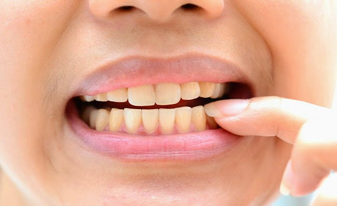 Bệnh nhân nên nhớ là tẩy trắng răng không thể làm một lần mà trắng được, vì tẩy trắng với thuốc phải để cho chất thuốc có thời giờ ngấm vào ngà răng từ từ, nếu dùng hóa chất mạnh, nồng độ peroxide cao chỉ làm ngà răng ê buốt chứ không thể ép cho ngà trắng nhanh được.