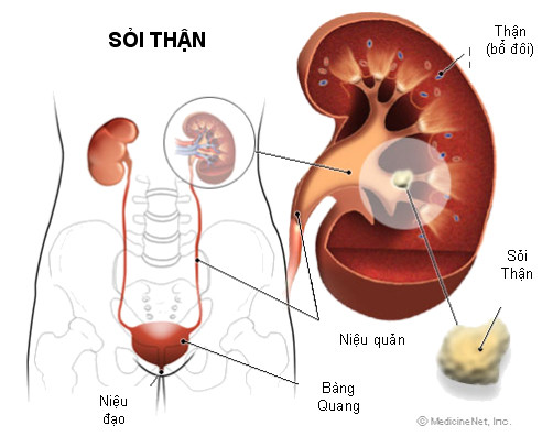 1. Uống đủ nước. Bác sĩ Julio Davalos, Giám đốc Khoa nội tiết niệu và thận tại Đại học Maryland Baltimore (Trung tâm Y khoa Washington, Mỹ) cho hay, thủ phạm lớn nhất của sỏi thận là mất nước. Do đó, uống đủ nước cách đơn giản để ngừa sỏi thận. Mặt khác, khoáng chất trong các thực phẩm chúng ta ăn hàng ngày như canxi, oxylate, phosphate hay axit uric...cơ thể cần phải có đủ nước để hòa tan chúng.