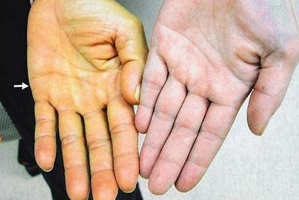Da chuyển màu vàng. Da trên cơ thể chuyển vàng khiến nhiều người nhầm tưởng mình mắc bệnh da liễu. Thực tế, nguyên nhân gây vàng da ở người lớn thường bắt nguồn từ các bệnh lý ở gan như viêm gan, xơ gan hay ung thư gan.