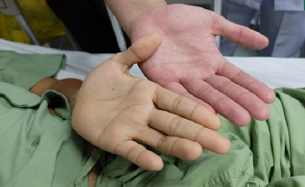 Ngoài hiện tượng da chuyển vàng, người bị bệnh gan còn có biểu hiện niêm mạc, nước tiểu và phân có màu bất thường.