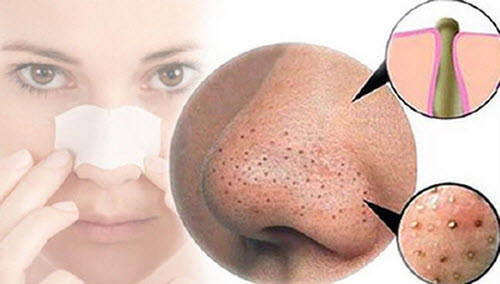 Loại bỏ tác nhân gây mụn đầu đen. Làn da bị xâm hại bởi hóa chất, khói bụi, không khí ô nhiễm sẽ rất dễ bị “ngộ độc” và có nguy cơ phải đối mặt với những rắc rối như viêm da, viêm nang lông, tiết nhiều chất nhờn, cặn bã và mụn trứng cá là kẻ thù đáng sợ nhất của da trong tình trạng này.