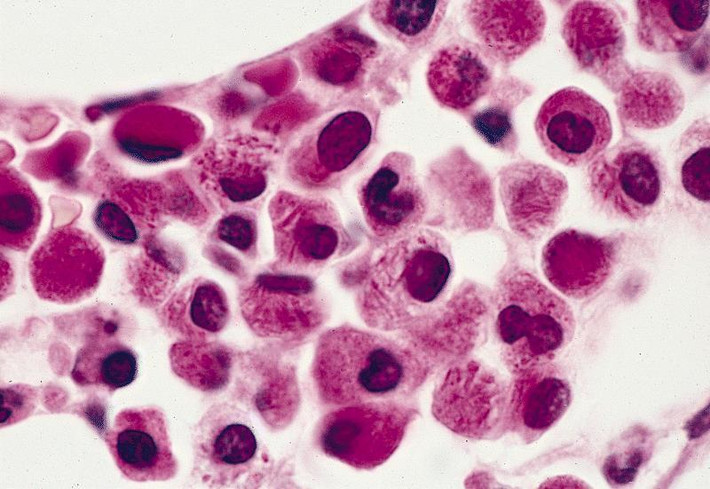 Tuy nhiên, sự thay đổi trong một nhiễm sắc thể khiến cho các tế bào myelocytic không thể trưởng thành. Nó có thể tụ hợp các tế bào khỏe mạnh trong tủy xương và gây trở ngại cho việc sản xuất tế bào máu bình thường.