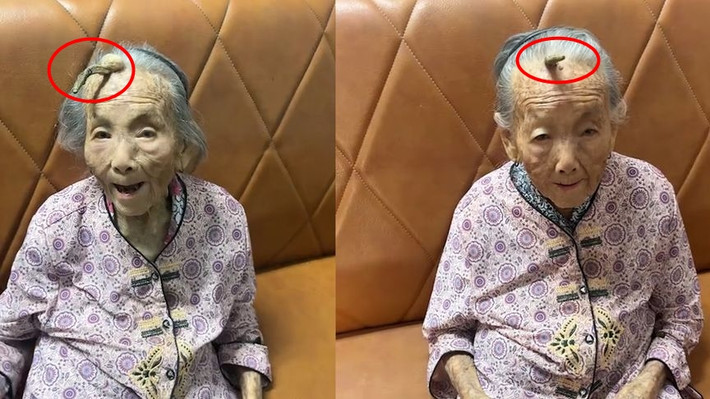 Một trường hợp "quái nhân" kỳ lạ đang thu hút sự chú ý của dư luận tại thành phố Phổ Ninh, thị Yết Dương, tỉnh Quảng Đông, Trung Quốc. Bà Trần, 107 tuổi, bất ngờ mọc sừng trên trán, khiến gia đình, hàng xóm và nhiều người địa phương không khỏi choáng váng, đặt câu hỏi về nguyên nhân. (Ảnh: Sohu, Sinchew, Ixigua)