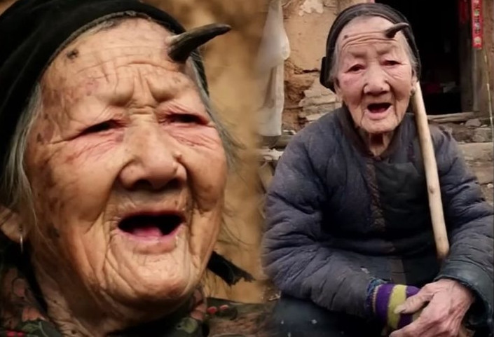 Ông khuyến cáo: "Nên phòng tránh tiếp xúc với ánh nắng mặt trời. Nếu phát hiện sừng da, nên đến bệnh viện khám chữa bệnh kịp thời để xác định rõ bản chất bệnh. Nếu kết quả kiểm tra cho thấy bệnh lành tính, có thể cắt bỏ sừng. Nếu bệnh ác tính, cần điều trị thêm. Việc sừng da có mọc lại hay không phụ thuộc vào bản chất (lành tính hay ác tính) và độ sâu của bệnh".