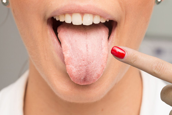 Đau lưỡi: Nếu người già bị đau lưỡi không rõ nguyên nhân thì rất có thể do viêm mao mạch. Người bệnh tuyệt đối không nên chủ quan, nên đi khám toàn thân để tìm nguyên nhân chính xác. Nhiều trường hợp, đau lưỡi không chỉ ảnh hưởng đến quá trình ăn uống mà còn là dấu hiệu của tai biến mạch máu não.
