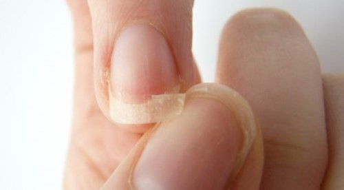 Móng tay giòn, dễ gãy - điều đó có nghĩa là bạn có thể bị nấm. Các chuyên gia sức khỏe giải thích rằng nấm phát triển ở môi trường ấm áp và lớp ẩm ướt của làn da là nơi chúng sống nhờ vào đó. Khi một ký sinh trùng xâm nhập vào, móng tay của bạn bắt đầu bị chia nhỏ ra và các cạnh vỡ vụn. Bác sĩ da liễu sẽ giúp bạn kê đơn thuốc. Bạn có thể hạn chế tiếp xúc với độ ẩm bằng cách đeo găng tay khi làm các món ăn hoặc thay đôi tất sau khi đi ra ngoài.