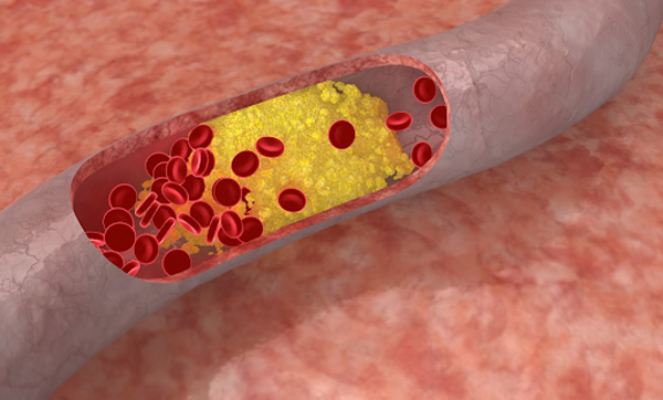 Khi mỡ máu cao, LDL-cholesterol dư thừa sẽ bám vào thành động mạch ngày một nhiều, hình thành các mảng bám dày, thu hẹp lòng mạch và làm giảm lưu lượng máu đến tim, não, chân tay,... Ngoài ra, các mảng bám cũng có thể vỡ ra, hình thành cục máu đông, gây ra nhiều biến chứng nguy hiểm như bệnh tim mạch, đột quỵ, tiểu đường, suy giảm chức năng gan... (Ảnh minh họa)