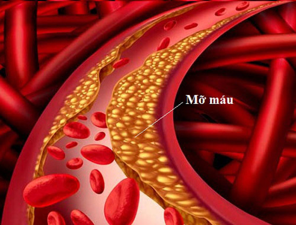 Để ngăn ngừa tình trạng mỡ máu cao, duy trì thói quen ăn uống lành mạnh có ý nghĩa quan trọng. Đặc biệt, tránh ăn nhiều 3 thực phẩm tăng mỡ máu dưới đây.