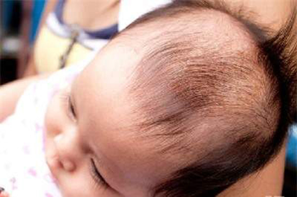 Giai đoạn đầu đời, các bé bắt đầu học lẫy, bò, đứng nên dễ ngã, bị thương ở đầu. Thóp có tác dụng như một cái đệm khi trẻ bị ngã và bảo vệ trẻ khỏi chấn thương não.