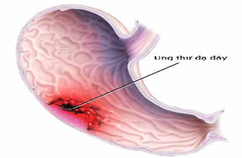 Hút thuốc đóng vai trò thuận lợi đáng kể trong việc dạ dày tá tràng loét nhanh hơn. Nó làm giảm lưu lượng máu niêm mạc dạ dày và ức chế dạ dày bài tiết chất nhầy làm cho bộ máy tiêu hóa thức ăn hoạt động kém.
