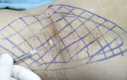 Bước 3, khoanh vùng điều trị hôi nách và tiến hành điều trị.