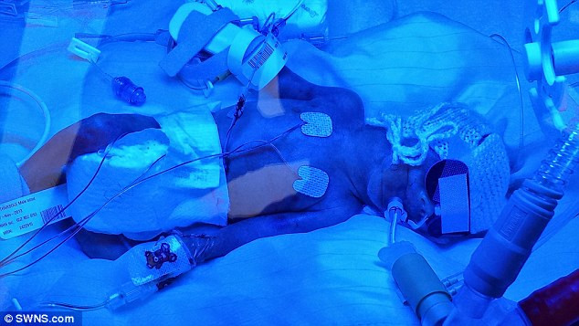 Ngày 2: Em bé sinh non được chăm sóc đặc biệt trong lồng ấp khi vừa chào đời.