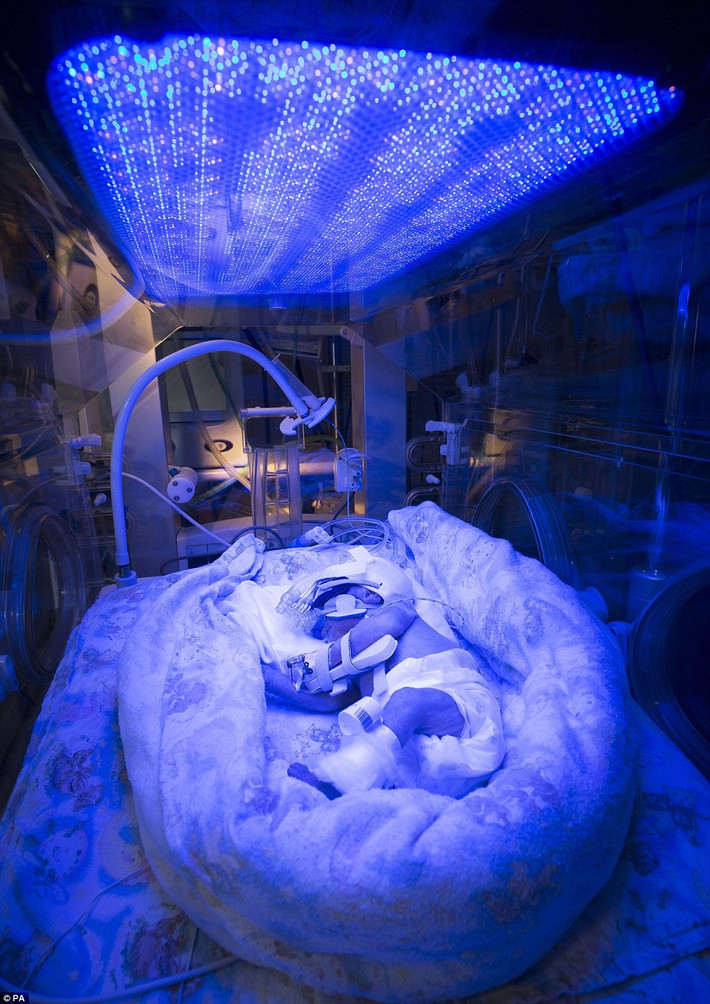 Hình ảnh em bé đắm chìm trong màn ánh sáng cực tím đoạt giải cao nhất. Em bé này vẫn đang được giữ sự sống của mình bởi một chiếc máy oxy đến phổi, ống dinh dưỡng lỏng và thuốc đi vào tĩnh mạch, đèn UV phá vỡ độc tố trong da thay cho gan.
