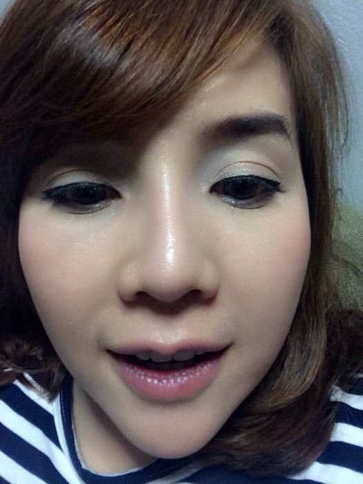 Đây là trường hợp phẫu thuật môi hiếm hoi, vì vậy cũng khó biết được liệu có biến chứng gì có thể xảy ra, nhất là khi khu vực môi tiếp xúc với nhiều loại thức ăn có thể dẫn đến nhiễm trùng nếu không được giữ vệ sinh cẩn thận.