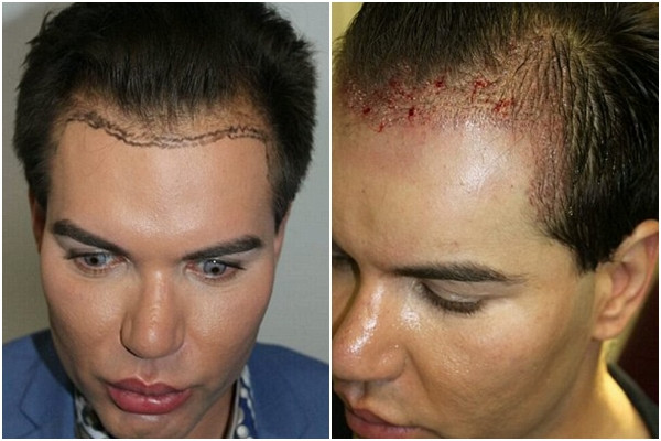 Anh chàng búp bê sống Ken, tên thật là Rodrigo Alves, người Brazil này đã thực hiện 32 ca phẫu thuật thẩm mỹ, tiêu tốn khoảng 208.000 pound (hơn 6 tỷ đồng), để thực hiện hút mỡ, độn silicone 6 múi, cấy lông mày, ghép da, tạo cơ bắp.