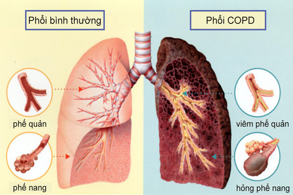 Bệnh phổi tắc nghẽn mạn tính (COPD) dẫn đến bệnh thủy đậu. So với những người bình thường, bệnh nhân COPD có nguy cơ mắc bệnh zona cao hơn - một căn bệnh gây đau đớn do vi rút thủy đậu gây nên.