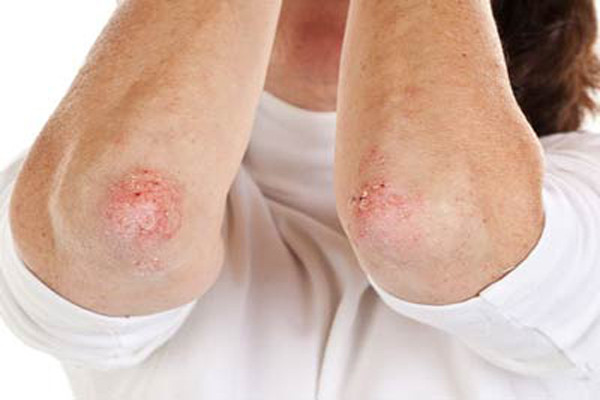 Bệnh vẩy nến kéo theo bệnh viêm khớp vẩy nến. Vẩy nến là một loại bệnh sinh ra từ sự tự miễn dịch của cơ thể. Nó thường xuất hiện những vảy ở khuỷu tay, đầu gối hoặc da đầu. Khoảng 7,5 triệu dân số Mỹ đã tiếp tục phát triển bệnh viêm khớp vẩy nến từ bệnh vẩy nến. Bệnh viêm khớp vẩy nến làm cho các xương khớp đau nhức và nếu như bạn không chăm sóc điều trị kịp thời có thể các khớp xương sẽ bị tổn thương vĩnh viễn làm tăng nguy cơ đột quỵ và nhồi máu cơ tim.