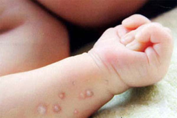Bạn hãy đến cơ sở y tế để tiêm vắc-xin zona một lần giúp phòng ngừa và giảm tác động của bệnh. Nếu bạn bị bệnh COPD, hãy nói chuyện với bác sỹ về việc tiêm chủng phòng ngừa bệnh thủy đậu.