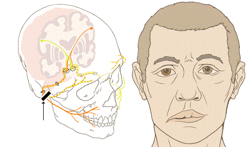 Bệnh tê liệt thần kinh mặt hay còn gọi là bệnh Bell’s Palsy là một bệnh ít nguy hiểm đến tính mạng. Bệnh xảy ra khi dây thần kinh điều khiển các cơ mặt bị viêm và bị chèn ép. Tuy mọi lứa tuổi đều có thể mắc bệnh, nhưng ít gặp ở người dưới 15 và trên 60 tuổi. Rất nhiều người nhầm tưởng đây là bệnh đột quỵ nhưng thực ra nó chỉ ảnh hưởng về mặt thẩm mỹ và gây bất tiện trong đời sống sinh hoạt chứ không nguy hại nhiều đến sức khỏe của bạn.
