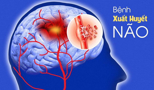 Bệnh nhân xuất huyết não nặng có tỷ lệ tử vong cao, tiên lượng phụ thuộc chủ yếu vào kích thước khối máu tụ trong não. May mắn thay, trước khi tình trạng xuất hiện, cơ thể sẽ phát những dấu hiệu cảnh báo xuất huyết não điển hình.