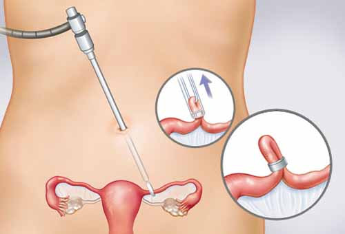Thắt vòi trứng. Đây là phương pháp tránh thai vĩnh viễn, nên chỉ có thể được áp dụng nếu các mẹ không muốn sinh con nữa. Phương pháp này áp dụng sau khi sinh 24 giờ đầu hay 6 tuần lễ đầu sau sinh. Đây là phương pháp tránh thai cầu kỳ cần được thực hiện ở các cơ sở y tế chuyên khoa, và không hề ảnh hưởng đến việc cho con bú.