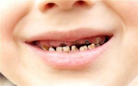 Ngoài ra, việc mút núm vú giả sẽ tạo lực ép vào hàm làm cho răng và xương hàm phát triển lệch lạc, ảnh hưởng đến cấu tạo của hàm trên và hàm dưới dẫn đến việc trẻ sẽ bị hô. Ngoài ra, do hàm không phát triển ra hai bên được, trẻ con có thể bị hẹp hàm.