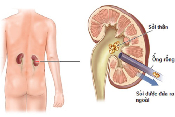 Vì vậy, bệnh nhân phải phòng ngừa, tránh tái phát bằng cách thay đổi cách sống và thực đơn ăn uống của mình như ăn ít dầu mỡ, ít muối, uống 2 lít nước/ngày và thường xuyên tập thể dục. Ảnh: Wabbacsy.