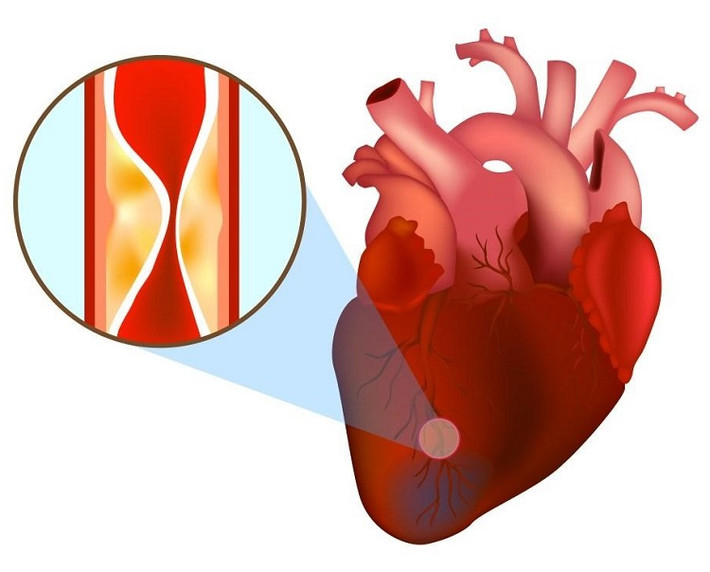 Nhồi máu cơ tim cũng có thể gây đau lan xuống vùng bụng, khiến người bệnh có cảm giác giống như bị ợ nóng do trào ngược dạ dày – thực quản. Ảnh: careplusvn.
