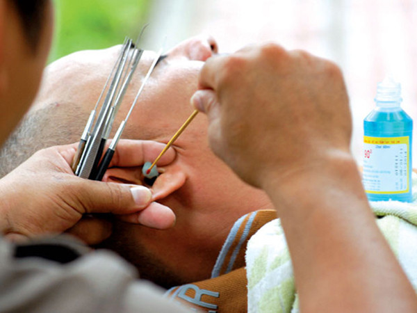 Trường hợp ráy tai dạng dầu, chúng có kết cấu dính nên khó tự chảy ra ngoài làm tắc ống tai, ảnh hưởng thính lực, gây ù tai. Để làm sạch, bạn nên đến khoa Tai mũi họng ở các bệnh viện để được làm sạch sâu. (Ảnh: nld.com.vn)