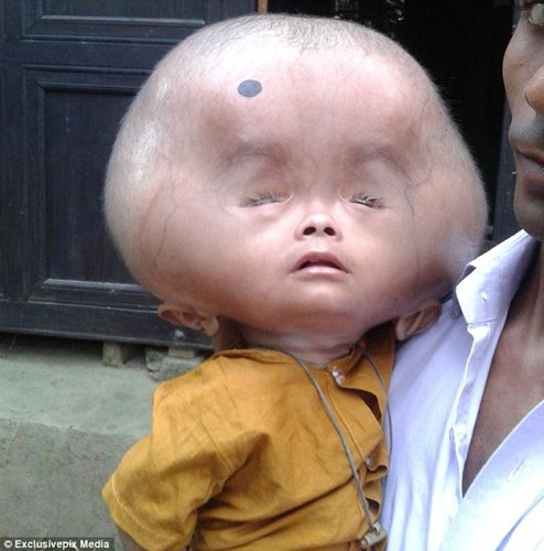 Một bé trai hai tuổi tên Emon tại Bangladesh có phần đầu khổng lồ nặng tới 9kg – tương đương với cân nặng trung bình của em bé một tuổi. Emon được sinh bằng phương pháp mổ, lúc mới sinh phần đầu của bé chỉ to hơn kích thước trung bình một chút nhưng hai năm qua đầu bé không ngừng tăng kích thước.