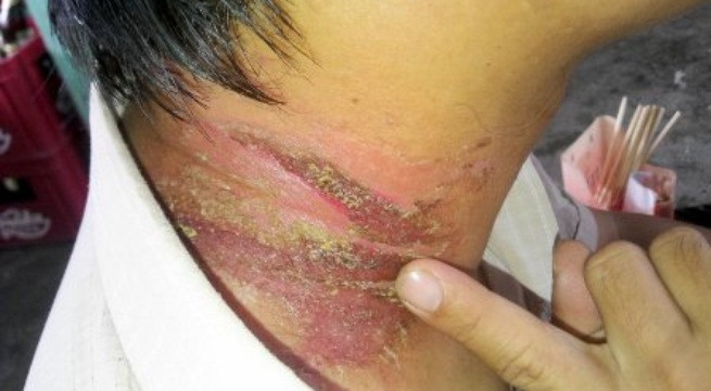 Một số trường hợp nhầm tổn thương là bị 'giời leo' (Zona) nên khám hoặc dùng thuốc dân gian đắp dẫn đến nhiễm trùng nặng hơn. Bác sĩ khuyên mọi người nên tránh những hành vi này. Ảnh: Vnmedia.