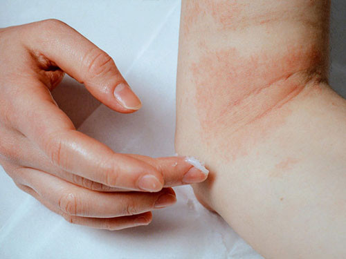 Thuốc bôi ngoài da. Di chuyển nhiều, việc va đập đôi khi có thể xảy ra, gây nên chấn thương nhỏ. Để không bị động, bạn nên chuẩn bị thuốc bôi bên ngoài, băng gạc. Nếu không sử dụng ngay, chúng vẫn cần thiết khi chấn thương trong các hoạt động ngày thường.