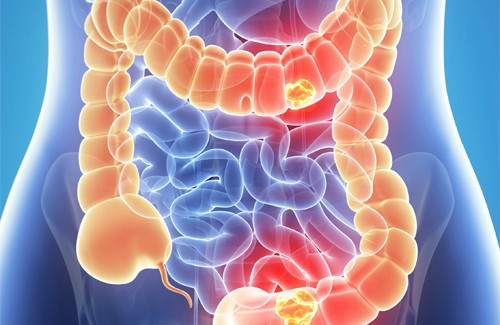 Mặt khác, những người từng bị ung thư đại tràng có thể có nguy cơ tái phát bệnh hoặc phụ nữ từng bị ung thư buồng trứng, ung thư cổ tử cung, ung thư vú cũng có nguy cơ bị ung thư đại tràng cao hơn.