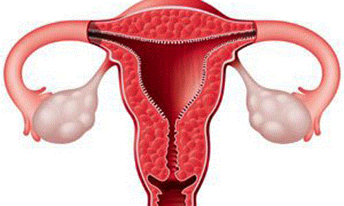 Mắc ung thư cổ tử cung do lây nhiễm virus HPV. Đa số các trường hợp bị ung thư cổ tử cung đều là do bị nhiễm virus HPV trong nhiều năm. Theo thống kê thì virus HPV có khoảng 100 chủng loại khác nhau, trong đó có khoảng 40 loại gây ra các bệnh liên quan đến hậu môn và bộ phận sinh dục và có 15 loại được liệt vào hàng nguy hiểm, có nguy cơ gây ung thư cao.